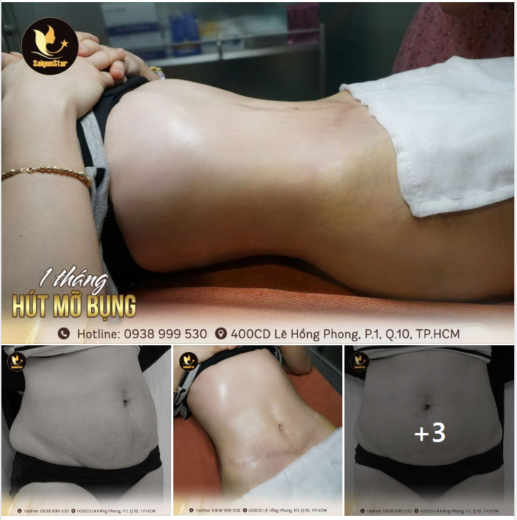 1 THÁNG HÚT MỠ BỤNG – ĐẸP CHUẨN GYMER
