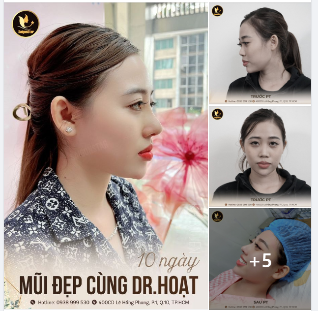 10 NGÀY MŨI ĐẸP CÙNG DR. HOẠT