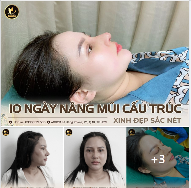 10 NGÀY NÂNG MŨI CẤU TRÚC SỬA LẠI – XINH ĐẸP SẮC NÉT