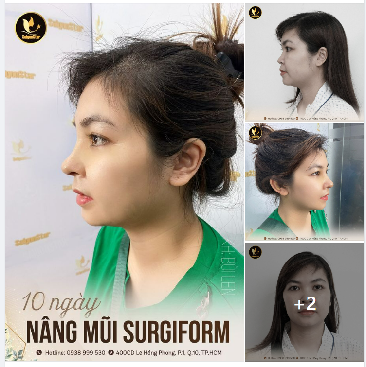 10 NGÀY NÂNG MŨI SURGIFORM – ĐẸP SẮC NÉT VỚI DÁNG MŨI MỚI