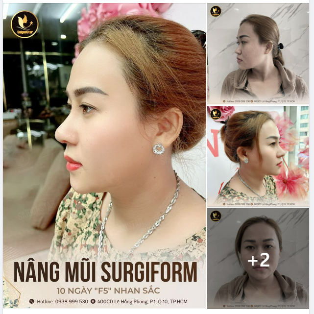 10 NGÀY NÂNG MŨI SURGIFORM  “F5” NHAN SẮC TOÀN DIỆN