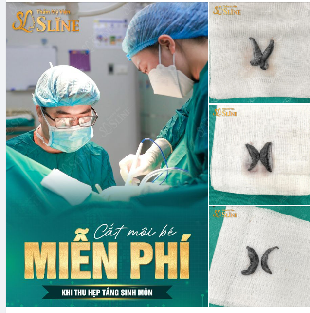 10 suất duy nhất Tặng Miễn Phí cắt môi bé