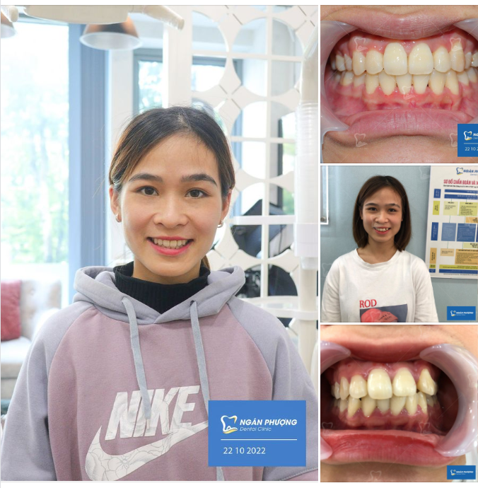 2 năm nên một hàm răng đẹp xinh mỹ mãn! Chúc mừng Bùi Diệu đã “về đích" thành công.