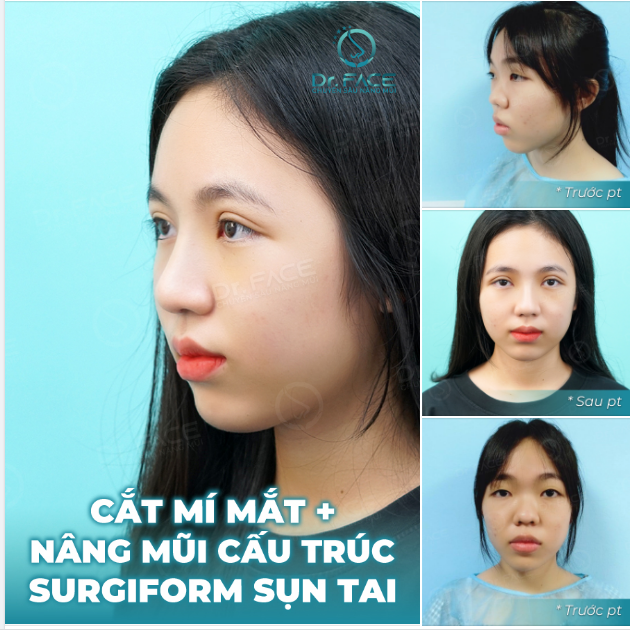 2,3 CON MỰC…COMBO MŨI + MÍ XINH CỰC…!