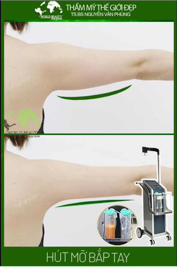 3 không với giải pháp hút mỡ bằng công nghệ tia nước Body jet Evo