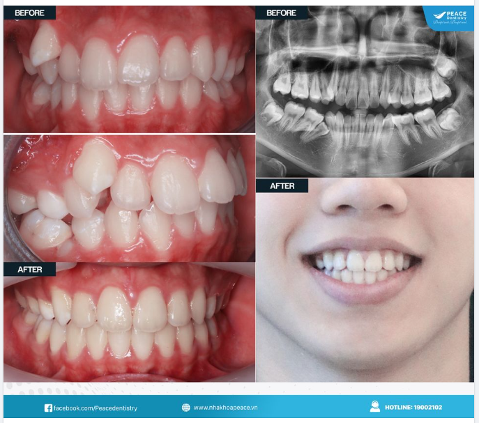 3 THÔNG TIN CỰC KỲ HỮU ÍCH MÀ CÁC BẠN CÓ HÀM RĂNG KHẤP KHỂNH NÊN BIẾT
