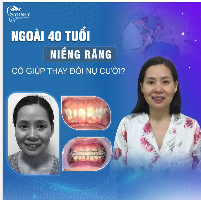 40 tuổi niềng răng có giúp thay đổi nụ cười?