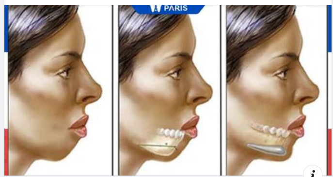7 ĐIỀU CẦN BIẾT TRƯỚC KHI THỰC HIỆN TRƯỢT CẰM, ĐỘN CẰM