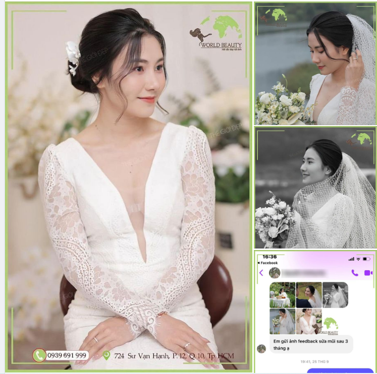 9X Gia Lai cũng không ngoại lệ, tìm đến Thế Giới Đẹp và quyết định can thiệp bằng giải pháp n.âng mũi cấu trúc sụn tự thân kết hợp thanh Surgiform sau 3 tháng.