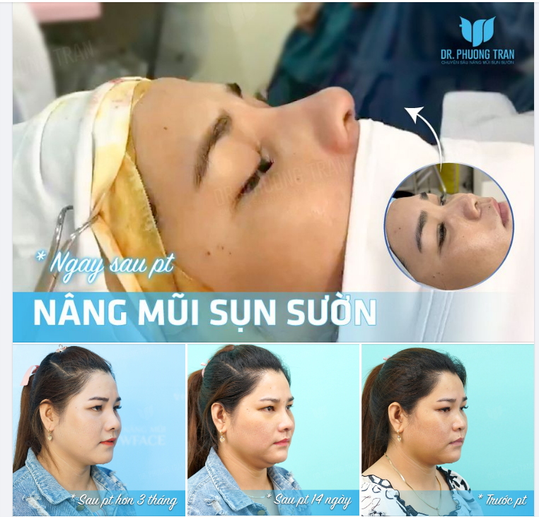 AI MUỐN “XIN VÍA” MŨI ĐẸP KHÔNG NÀO