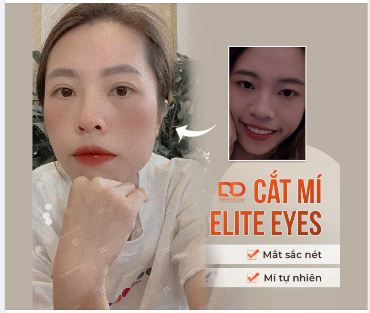 Ai nói Cắt mí bị già, chứ khách hàng của DrD lại TRẺ RA VÀI TUỔI...
