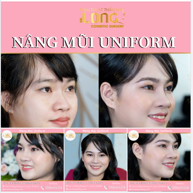 Bác sĩ Long sẽ giúp bạn tìm ra phương pháp phù hợp và sở hữu dáng mũi đẹp an toàn theo thời gian.