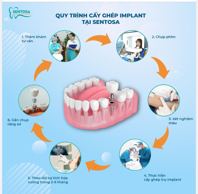 BẠN CÓ BIẾT QUY TRÌNH CẤY GHÉP IMPLANT TIÊU CHUẨN TẠI SENTOSA DIỄN RA NHƯ THẾ NÀO CHƯA?