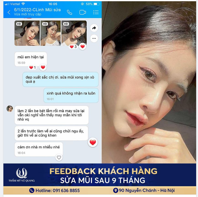 Bạn có hiểu cảm giác 2 lần sửa mũi đầy đau đớn nhưng vẫn hỏng
