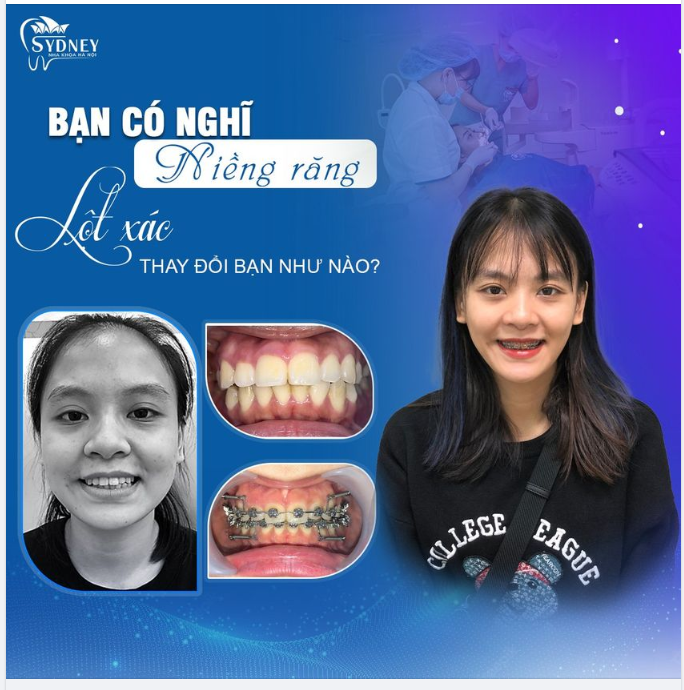 Bạn có nghĩ niềng răng thay đổi khuôn mặt?