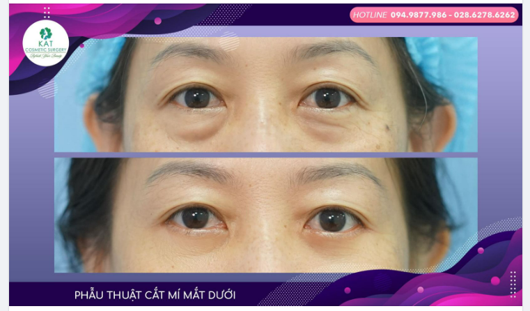 Bạn có thể trẻ hơn bao nhiêu tuổi sau phẫu thuật mí mắt dưới