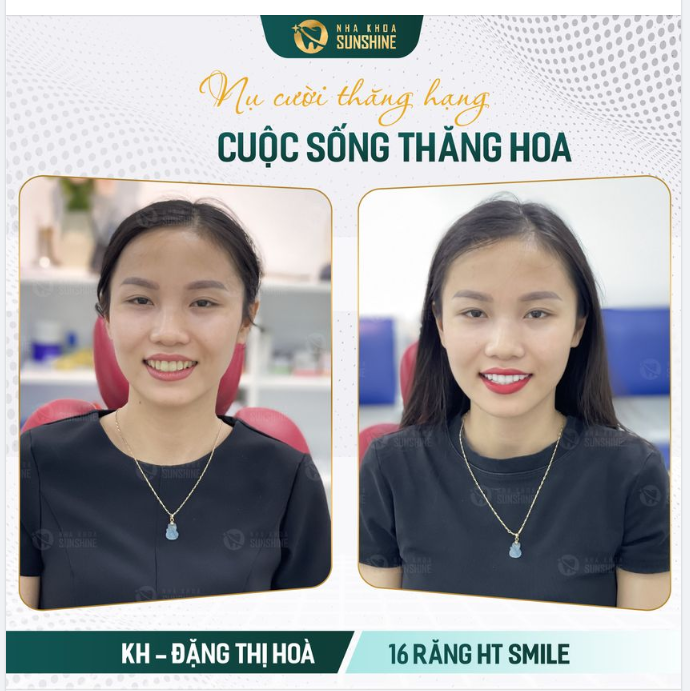 Bạn không biết  Bọc răng sứ thẩm mỹ giúp bạn  thay đổi như thế nào cho đến khi bạn là người trải nghiệm.