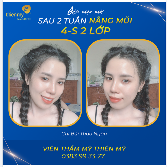Bất ngờ sau khi Nâng mũi 4-S 2 lớp của chị Thảo Ngân
