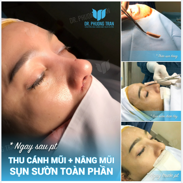 BÍ QUYẾT BIẾN CHIẾC MŨI THÔ CỨNG THÀNH TỰ NHIÊN LÀ…