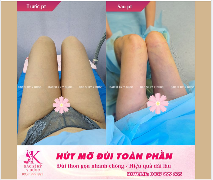 BÍ QUYẾT CÓ 1 CẶP ĐÙI THON GỌN
