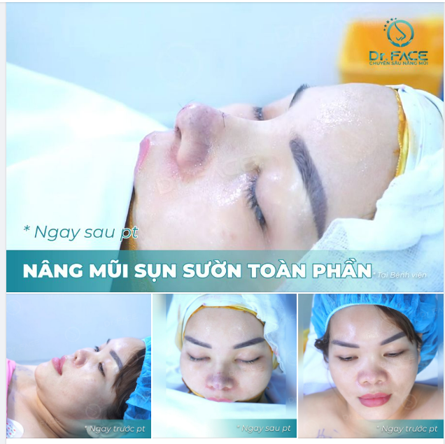 BÍ QUYẾT ĐỂ MẮT ĐẸP HƠN LÀ…NÂNG MŨI