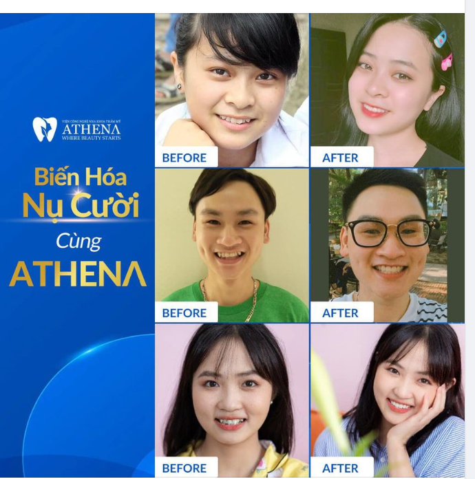 BIẾN HOÁ NỤ CƯỜI CƯỜI CÙNG NHA KHOA ATHENA