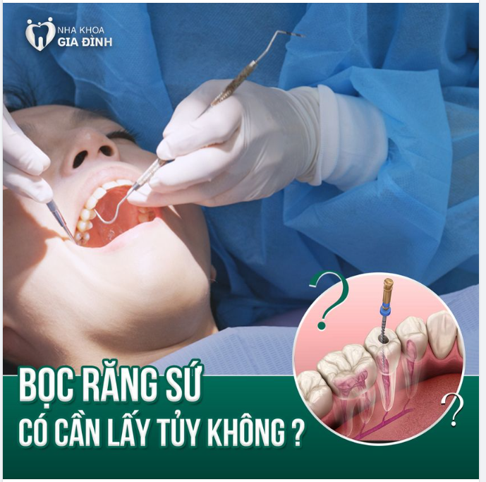 BỌC RĂNG SỨ CÓ CẦN PHẢI LẤY TỦY KHÔNG?