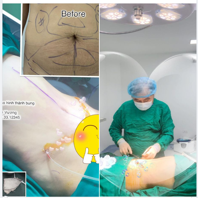 Bụng dư mỡ, dư nhiều da với rốn khá sâu, nhăn nhúm nhiều vùng xung quanh rốn đã được Dr Vương xử trí bằng phương án hút mỡ  tạo hình thành bụng (có dời rốn)…