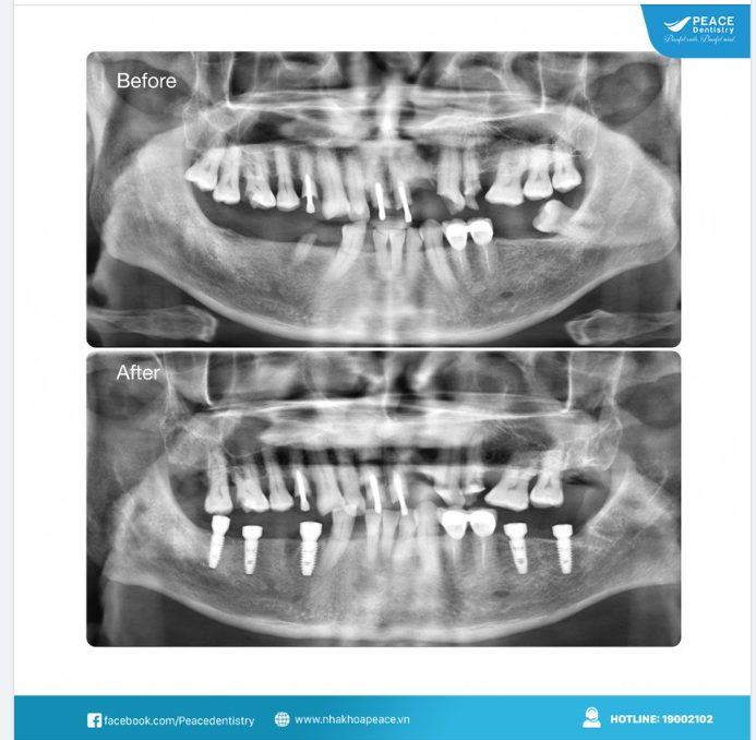 Ca lâm sàng cấy ghép 5 đơn vị implant cho khách hàng lớn tuổi, mất nhiều răng hàm dưới.