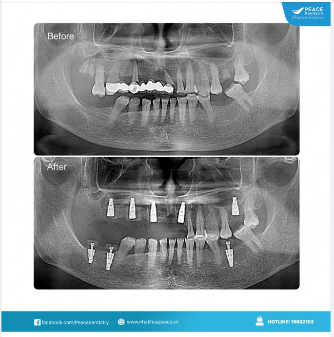 Ca lâm sàng cấy ghép 8 đơn vị Implant cho khách hàng lớn tuổi