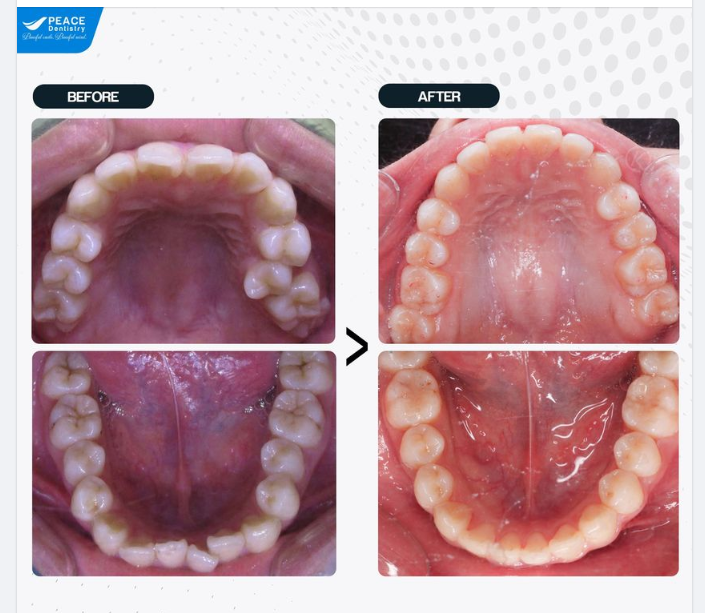 CA LÂM SÀNG CHỈNH NHA VỚI MẮC CÀI TỰ ĐÓNG
