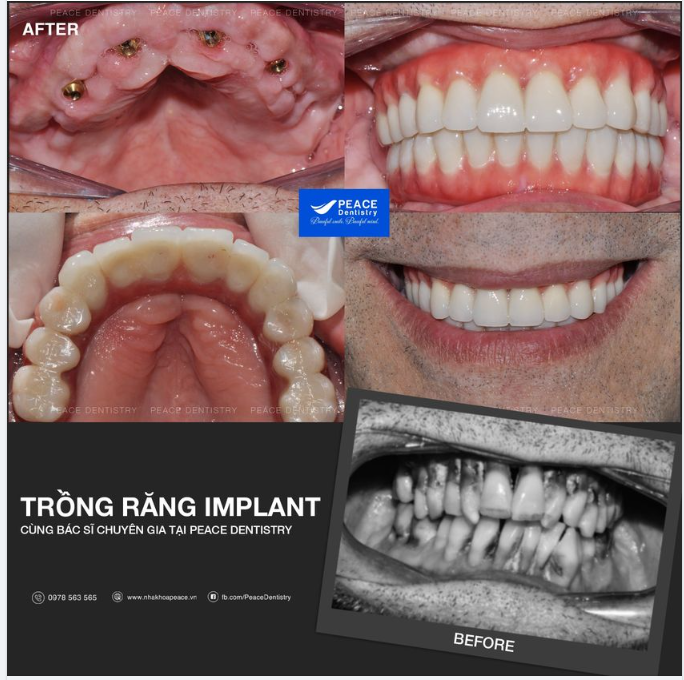 Ca lâm sàng minh họa là ca Implant toàn hàm (all-on-4 Implant) cho một khách nước ngoài bị viêm nha chu nặng trên toàn hàm, răng lung lay gần hết và buộc phải nhổ bỏ răng.