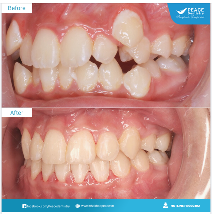 CA LÂM SÀNG NIỀNG RĂNG CHEN CHÚC VỚI MẮC CÀI KIM LOẠI