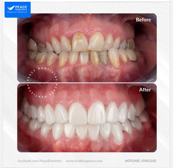 Ca lâm sàng thẩm mỹ răng sứ (Zirconia DDBio - Dental Direkt, made in Germany) đáp ứng kỳ vọng của khách hàng về một nụ cười rạng rỡ và nhìn trông tự nhiên!