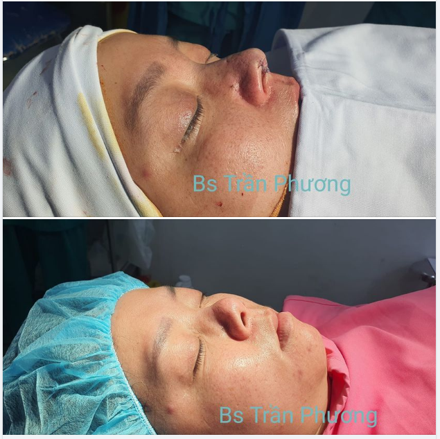 Ca mổ rất khó và rất mệt.