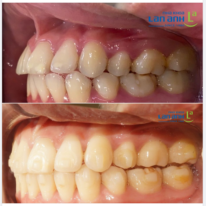 Ca niềng tại chi nhánh Phú Mỹ Hưng, quận 7, do bác sĩ Thảo và bác sĩ Tuấn Anh điều trị.