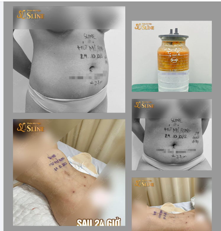 Các bạn cứ thắc mắc là Bụng to như vậy hút mỡ xong thì sẽ như thế nào và có đau Không, có phải nghỉ ngơi lâu không