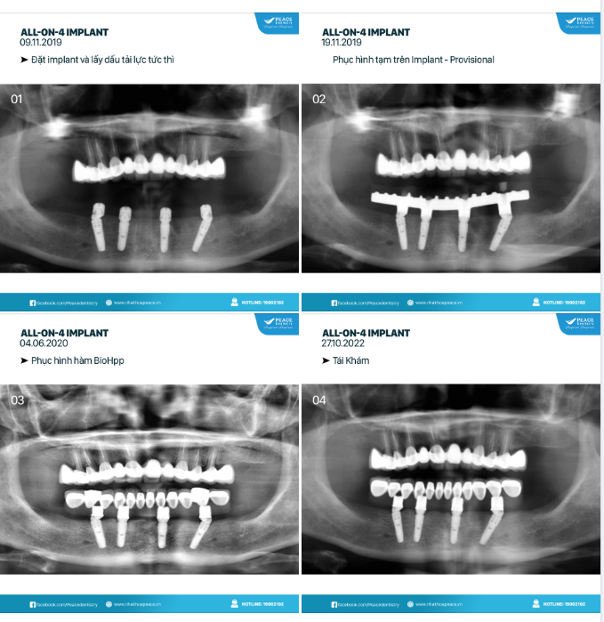 Các hình ảnh theo thời gian của một ca lâm sàng  All on 4 Implant (Implant toàn hàm) tại Peace Dentistry