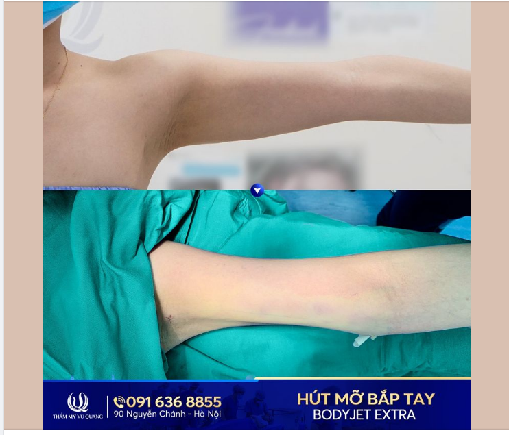 Các nàng có biết hậu quả của hút mỡ bắp tay là gì không Là thon ,gọn ,đẹp hơn chứ sao