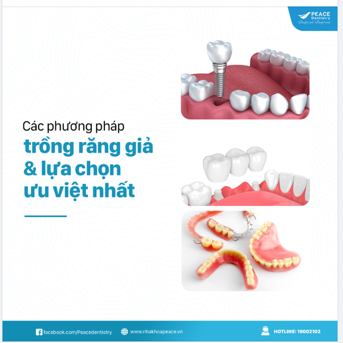 CÁC PHƯƠNG PHÁP TRỒNG RĂNG GIẢ PHỔ BIẾN HIỆN NAY