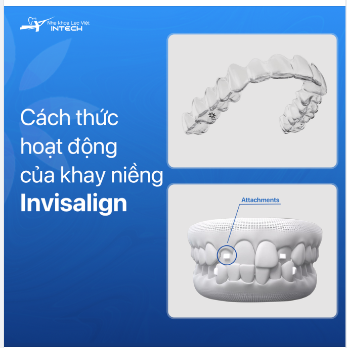 CÁCH THỨC HOẠT ĐỘNG CỦA KHAY NIỀNG INVISALIGN