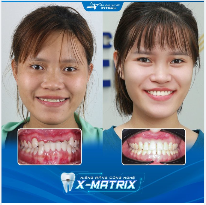 CẢI THIỆN KHỚP CẮN NGƯỢC VỚI CÔNG NGHỆ NIỀNG RĂNG X-MATRIX