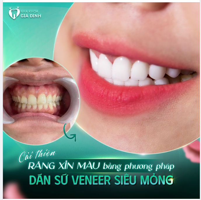 CẢI THIỆN MÀU RĂNG, TỰ TIN CƯỜI TỎA SÁNG