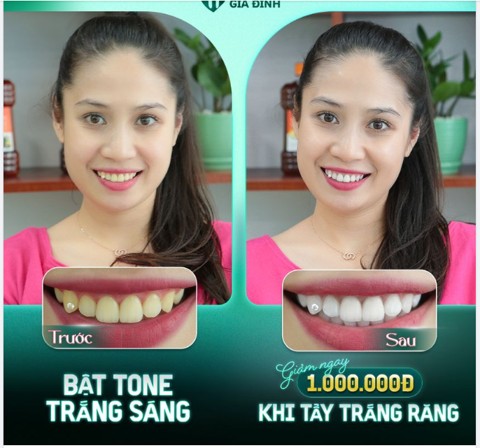 CẢI THIỆN RĂNG XỈN MÀU VỚI CÔNG NGHỆ TẨY TRẮNG RĂNG HIỆN ĐẠI