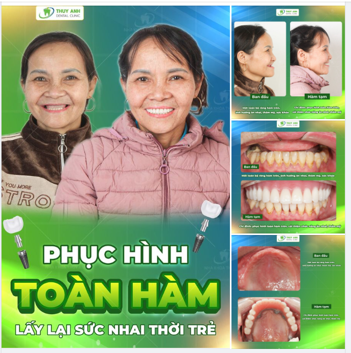 CẢI THIỆN THẨM MỸ - ĐẢM BẢO ĂN NHAI TRONG TRƯỜNG HỢP MẤT RĂNG TOÀN HÀM CHO BÁC DUNG