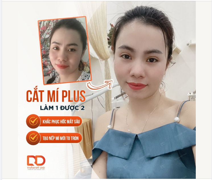 Cải thiện toàn bộ khuyết điểm của đôi mắt nhờ CẮT MÍ PLUS