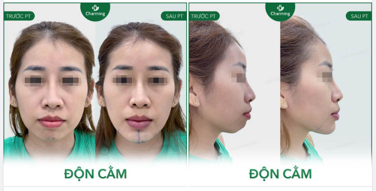 Cằm của khách vốn dĩ ngắn và lẹm sâu.