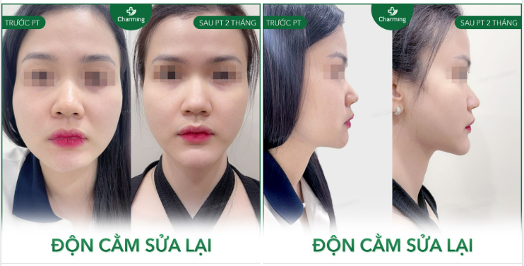 Cằm đẹp không phải chỉ cần đi độn là được, bạn còn phải trông chờ rất nhiều vào tay nghề bác sĩ và những yếu tố khác đòi hỏi người thực hiện phải có kỹ năng chuyên môn