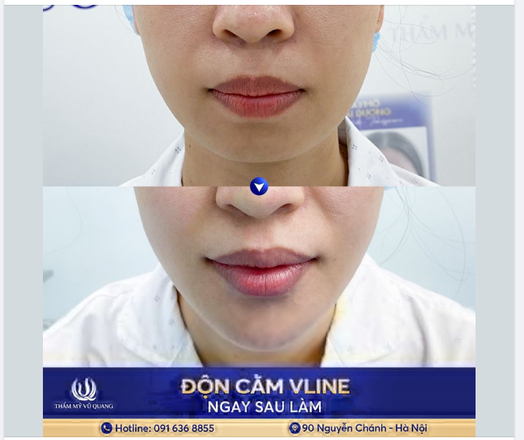 CẰM LẸM ​​​​​​​ - CẰM NGẮN - HOÁ V-LINE