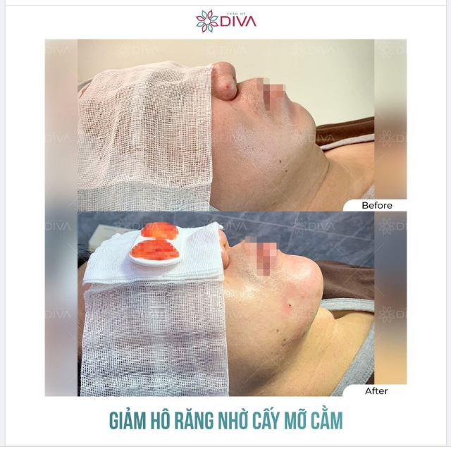 CẰM VLINE, MIỆNG GIẢM HÔ SAU CẤY MỠ COLEMAN